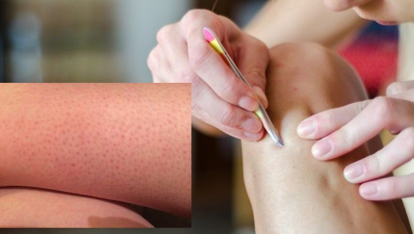 Cara Hilangkan Bintik Hitam Di Tangan : Ekqglxlfietorm : Itulah