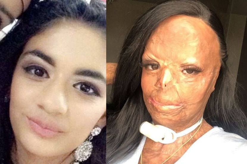 Gara Gara Pakai Syampu Untuk Singkirkan Kutu Gadis Alami Luka Terbakar Tahap Tiga Selepas Rambut Disambar Api Dunia Mstar