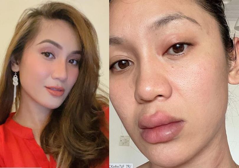 Bibir Dan Mata Ramona Zamzam Bengkak Dua Hari Derita Akibat Alahan Kelihatan Seperti Saya Buat Pembedahan Plastik Yang Gagal Hiburan Mstar