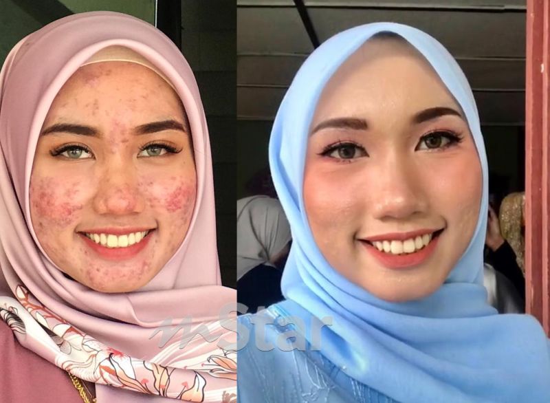 jerawat baru 1