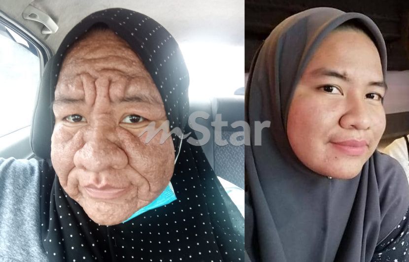 Pernah Simpati Wajah Ibu Hamil Jadi Orang Tua Sebab Alahan Wanita Ini Tak Sangka Diri Sendiri Pun Terkena Mula Mula Muka Jadi Sembab Viral Mstar
