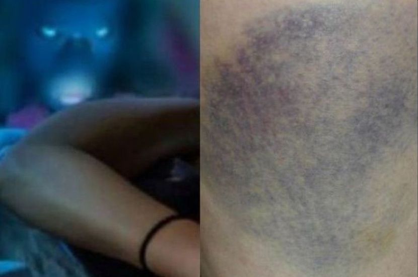 Kesan lebam pada paha sering dikaitkan dengan gangguan jin