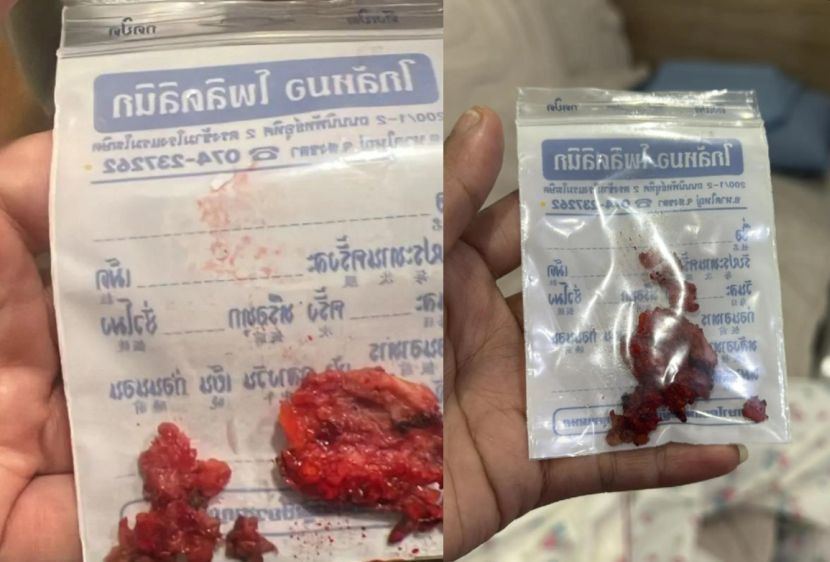 Silikon yang dikeluarkan dari wajah Nilam.