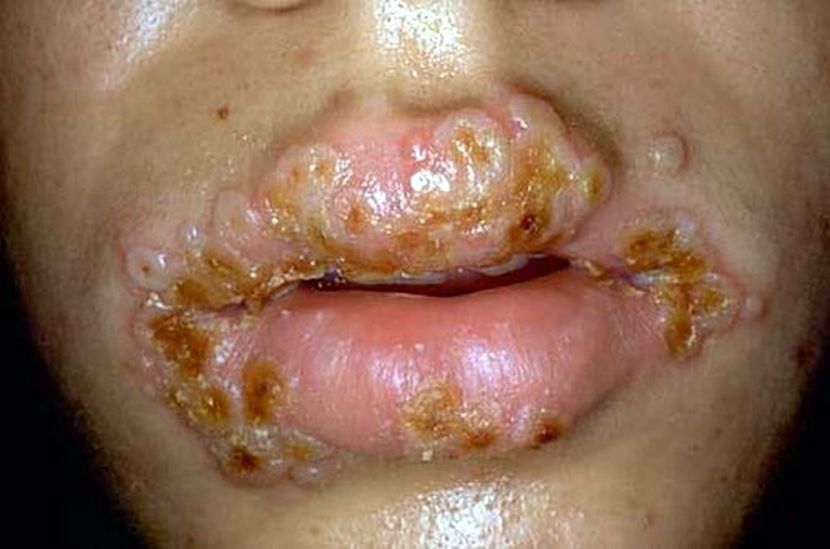 Herpes boleh menjangkiti sesiapa sahaja. -Foto Wikipedia Herpes