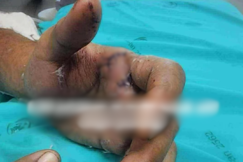 Kesan kecederaan yang didakwa dilakukan mangsa.