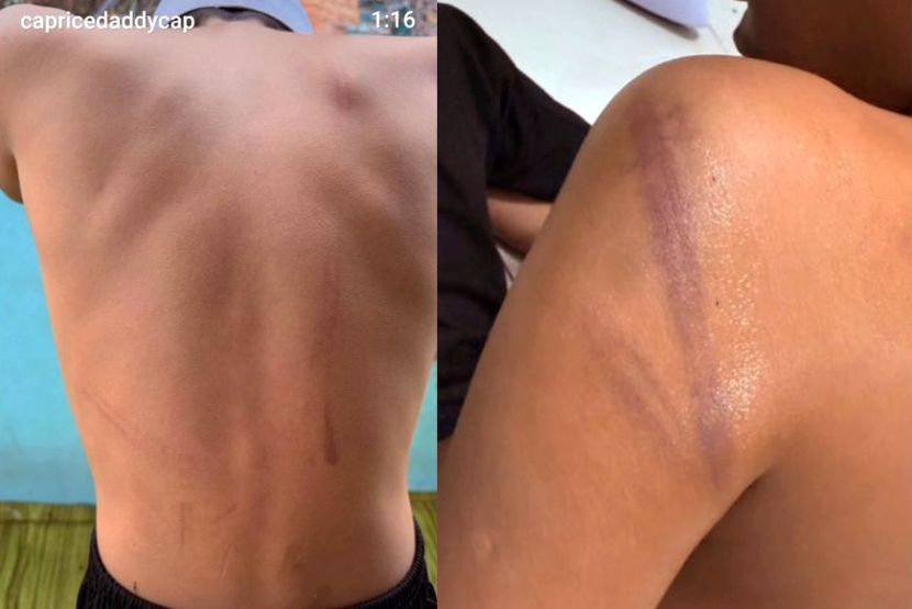 Kesan lebam yang disebabkan tindakan warden terbabit.