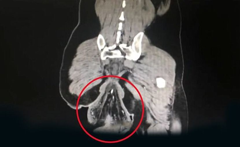 Gambar imbasan CT pesakit lelaki terbabit. 