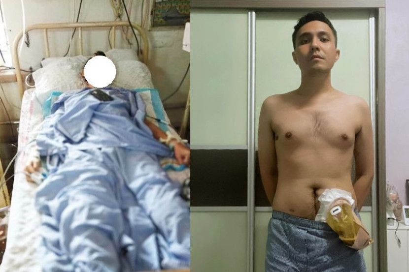 Safwan terpaksa memakai stoma disebabkan jangkitan tifoid yang dialami.